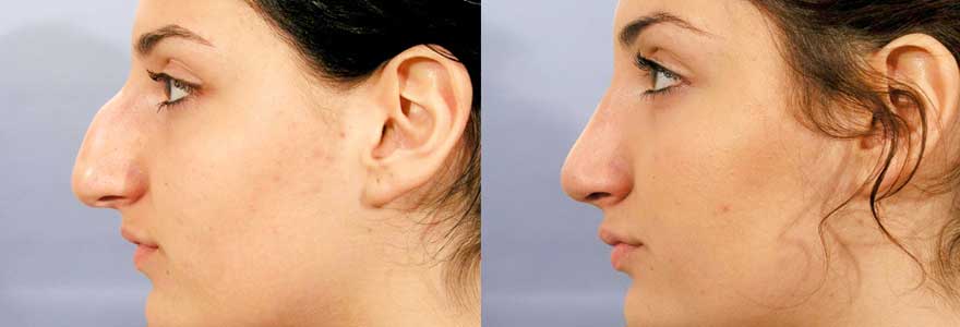 la Rhinoplastie